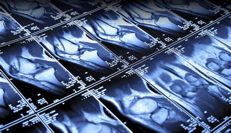 Image result for Arthogram Explained