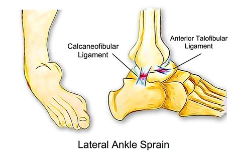 Ankle Sprain - Rural Physio at Your Doorstep | Physio Direct