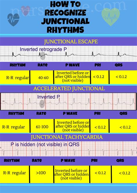 Junctional Rhythm InfoGraphic | Infographic