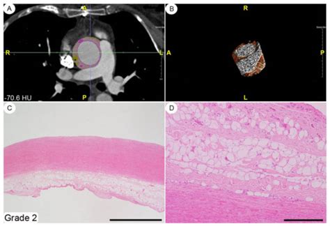 The Histopathological Correlate of Peri-Vascular Adipose Tissue ...