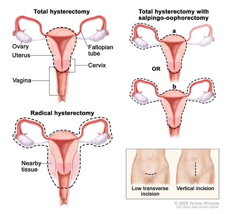 Definition of bilateral salpingo-oophorectomy - NCI Dictionary of ...