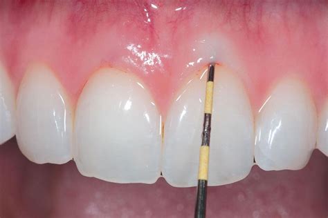 Image result for Gum Color