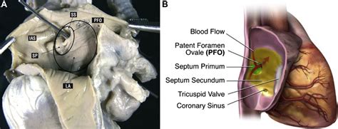Guidelines for the Echocardiographic Assessment of Atrial Septal Defect ...