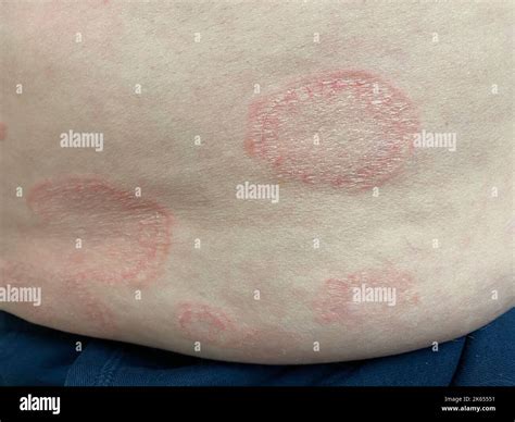 Erythema annulare centrifugum Stock Photo - Alamy