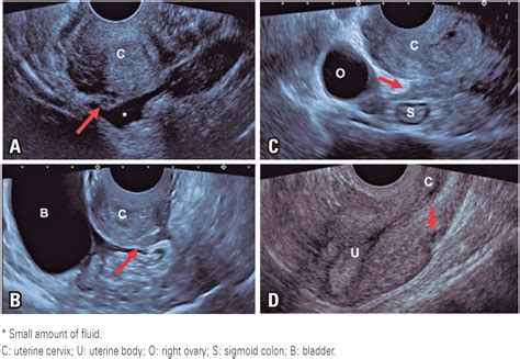 Negative Sliding Sign Endometriosis at Eric Maxwell blog