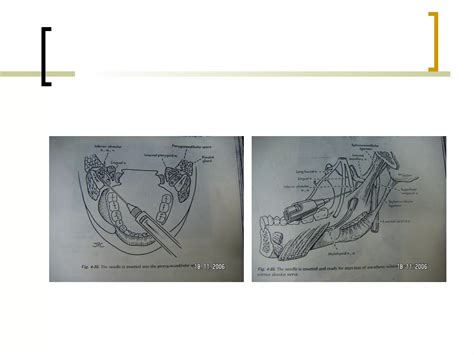 Local Anesthesia 的图像结果