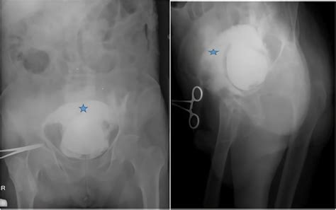 Image result for Bladder Explode