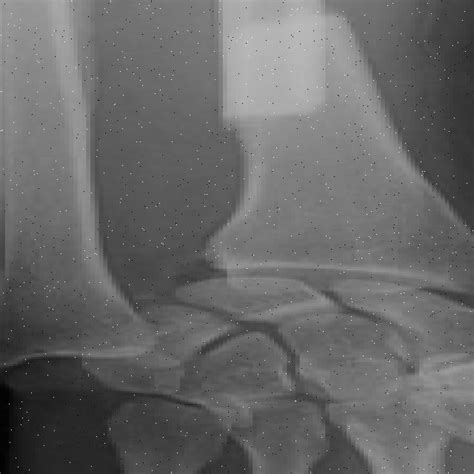 Bone Fracture Detection Using Image Processing Source Code GitHub 的图像结果