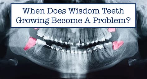 When Does Wisdom Teeth Growing Become A Problem? – B.WEISS Health