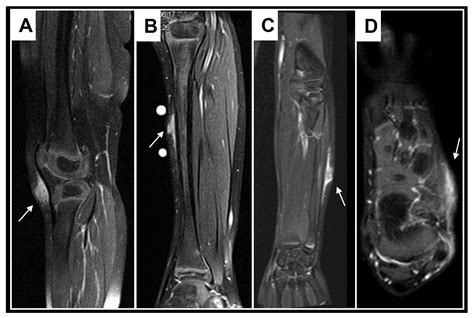 Subcutaneous Granuloma Annulare vs. Subcutaneous Vascular Malformations ...