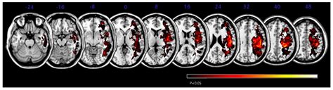 Is Lateropulsion Really Related with a Specific Lesion of the Brain?