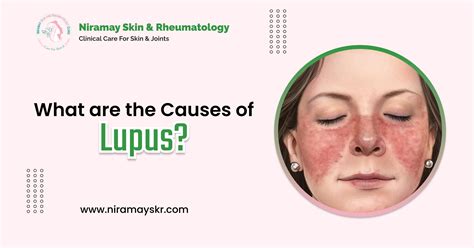 What are the Causes of Lupus | Niramay Skin & Rheumatology Clinic