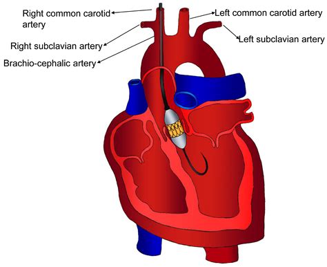 Exploring Optimal Strategies for Surgical Access in Transcatheter ...