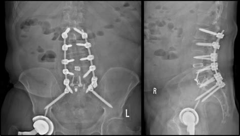 L5-S1 Anterior lumbar interbody fusion