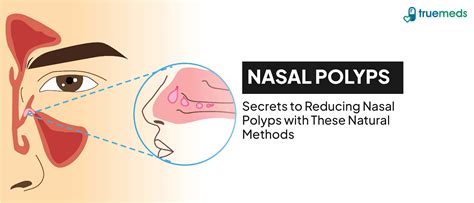 Nasal Polyp Causes Symptoms Diagnosis Treatment