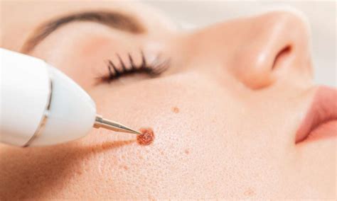 Best Dark Spot Remover for Face | Skin Whitening Laser Treatment