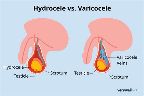 Varicocele Grading Varicocele — Urology Care Toowoomba | Dr Nikhil