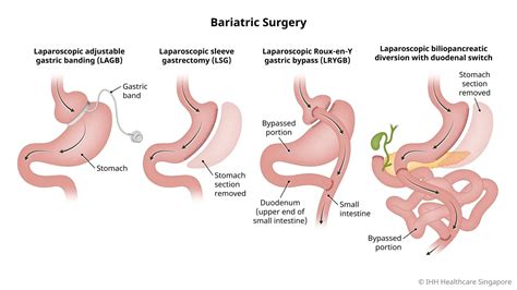 Bariatric Surgery | Parkway Shenton