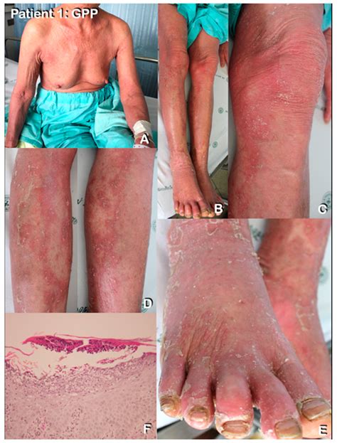 Loss of Function TGFBR2 Variant as a Contributing Factor in Generalized ...