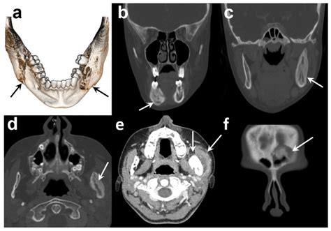 Chronic Osteomyelitis of the Jaw: Pivotal Role of Microbiological Investigation and ...