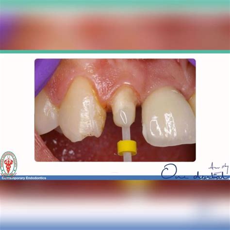 Post endodontic restorations-One Dental is the Biggest online platform ...