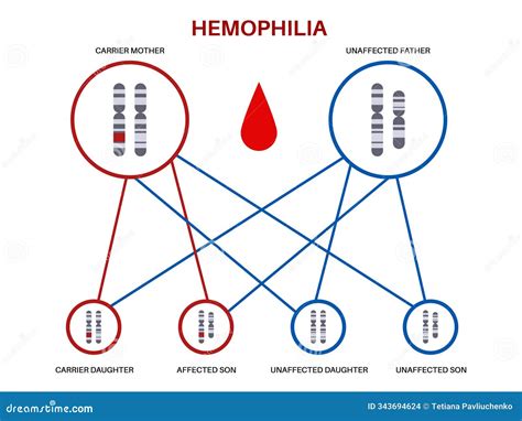 Hemophilia Inheritance Poster Stock Vector - Illustration of chromosome ...