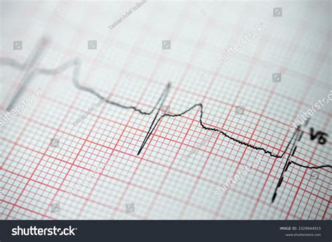Abnormal Electrocardiogram