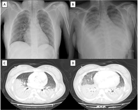 Acute Chest Syndrome in a Patient With Sickle Cell Disease: A Case Report | Open Respiratory ...