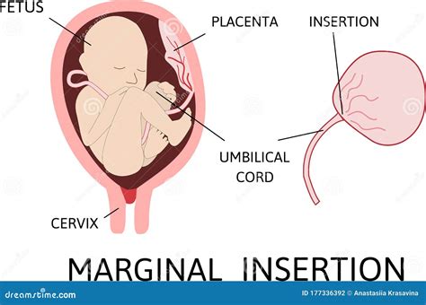Marginal Insertion Of Umbilical Cord. Insertion Site Varies Royalty ...