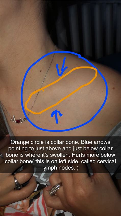 Swollen Lymph Nodes Above Collar Bone Lump On Collarbone: Causes,
