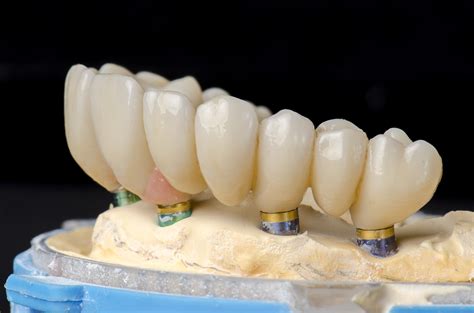 Full Dental Implants