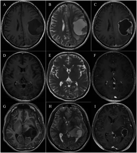 Frontiers | Spotlights on adult patients with pediatric-type diffuse gliomas in accordance with ...