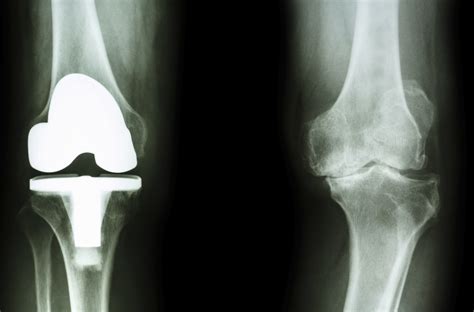 What Is Joint Arthroplasty at Ted Goldstein blog