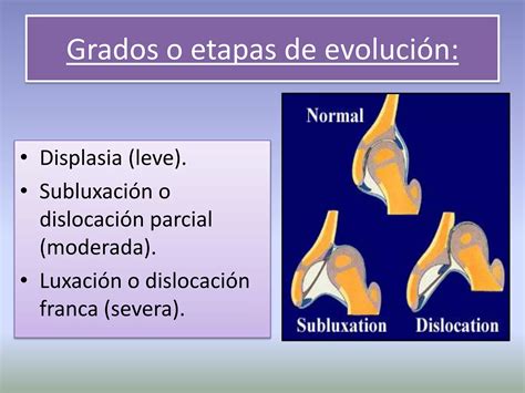 Displasia del desarrollo de las caderas | PPTX