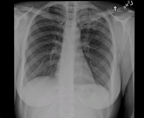 Chest X Ray Tb