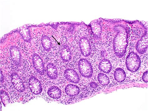Infectious Disease Pathology of the Gastrointestinal Tract - Surgical ...