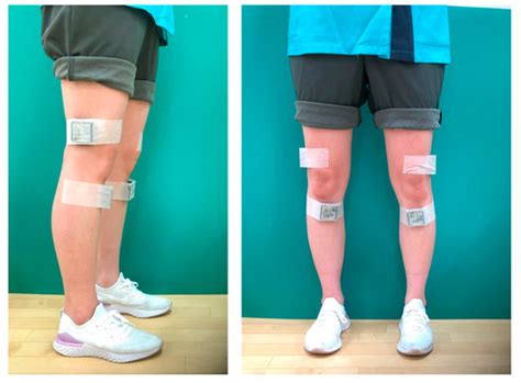 Applied Assessment Method for Varus Thrust during Walking in Patients ...