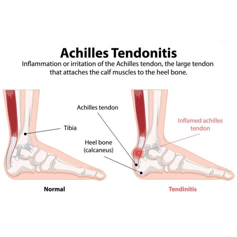 Achilles Tendonitis: Causes, Braces, & Recovery Solutions at ...