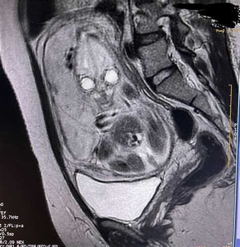 A photo of an MRI scan of a 26wks pregnant patient front and side angle ...