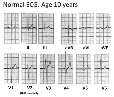 Normal ECG Read Out 的图像结果