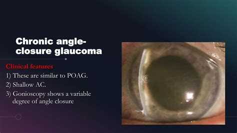 Primary angle closure glaucoma | PPTX