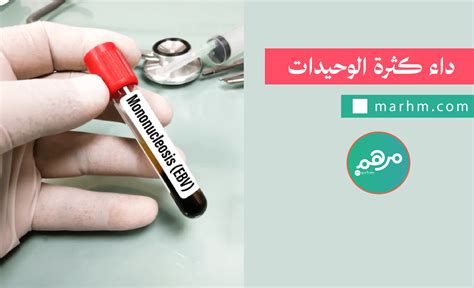 داء كثرة الوحيدات: الأسباب، الأعراض والعلاج - منصة مرهم