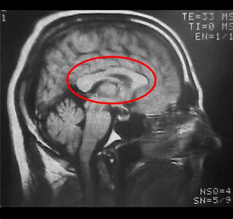 Agenesis of the Corpus Callosum - NODCC