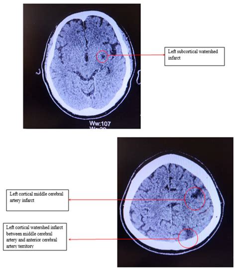 Unusual Evolution of Carotid Atherosclerosis in a Patient with ...