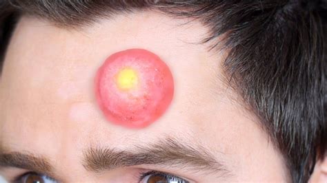 Exploding Pimples 2018 的图像结果