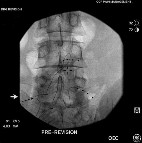Dorsal root ganglion stimulation lead fractures: potential mechanisms ...
