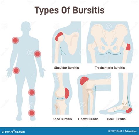 Types Of Bursitis Set. Shoulder, Hip, Heel, Knee And Elbow Joints Inflammation. Cartoon Vector ...