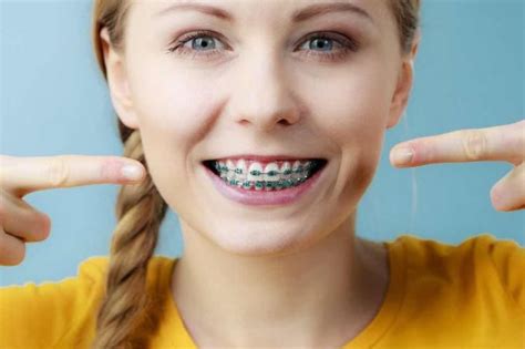 A Comprehensive Guide To Braces - Swipit