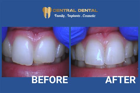Bonding Procedure For Chipped Teeth With Gap Case | Central Dental