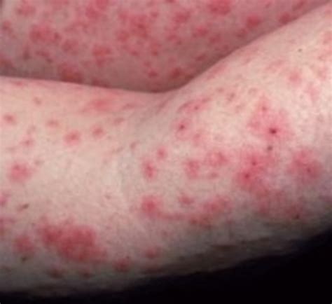 P.U.P.P.S...A Pregnancy Rash